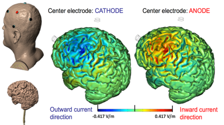 High Definition-Electroconvulsive Therapy – Soterix Medical