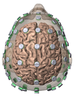 High Definition-Electroconvulsive Therapy – Soterix Medical