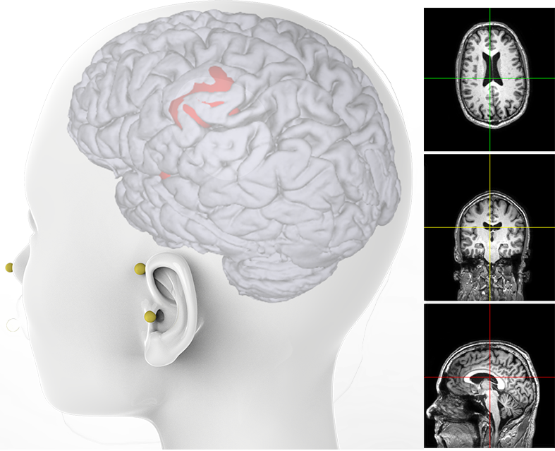 Soterix Medical MXN-33 High Definition-transcranial Electrical Stimulator